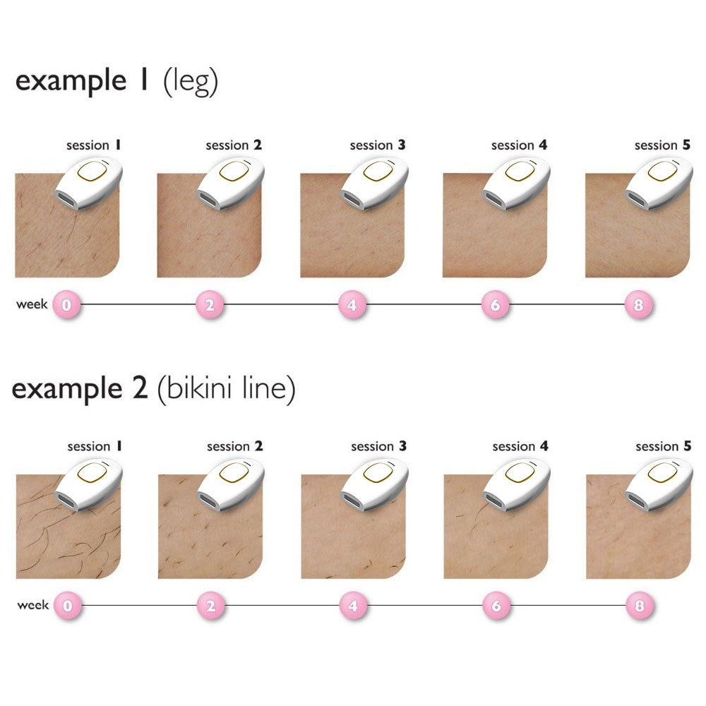 IPL Laser Remoção de cabelo Handheld Sistema de remoção de cabelo em casa